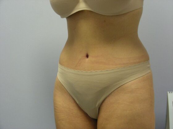 Tummy Tuck: Case 7 - After