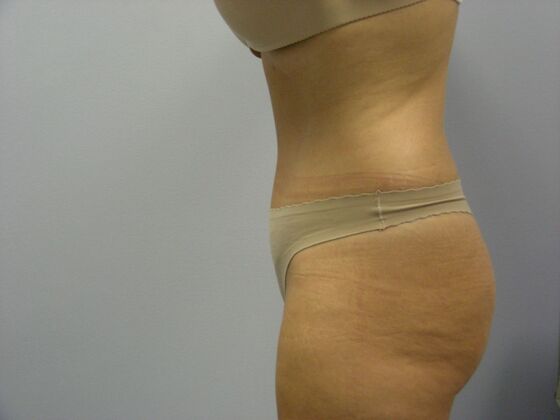 Tummy Tuck: Case 7 - After
