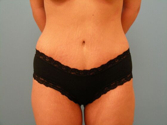 Tummy Tuck Case 8 - After