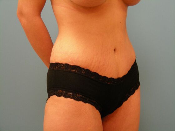 Tummy Tuck: Case 8 - After