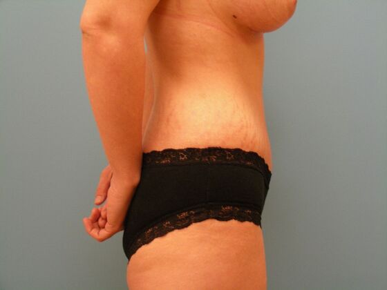 Tummy Tuck: Case 8 - After