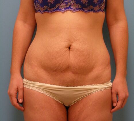 Tummy Tuck Case 8 - Before