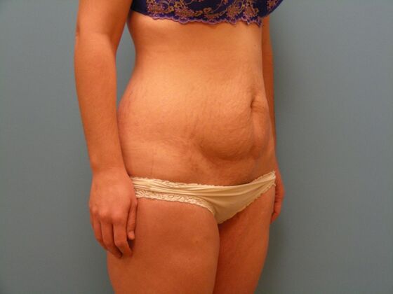 Tummy Tuck: Case 8 - Before
