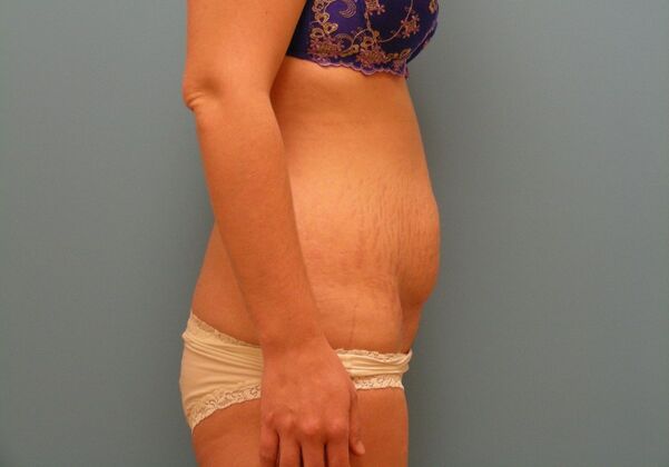 Tummy Tuck: Case 8 - Before