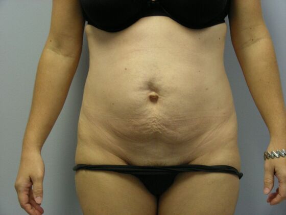 Tummy Tuck Case 9 - Before