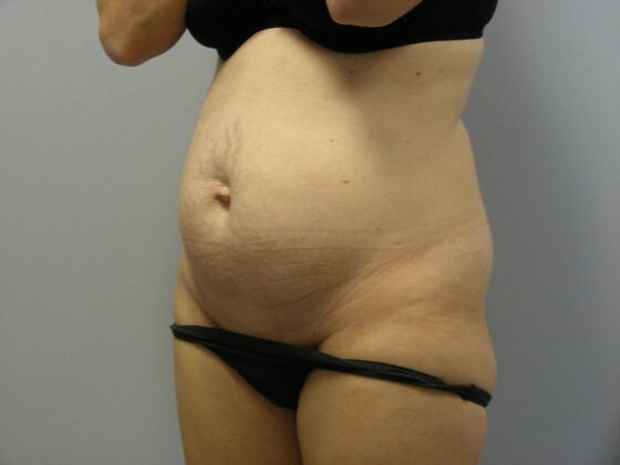 Tummy Tuck: Case 9 - Before