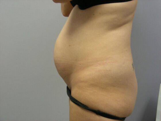 Tummy Tuck: Case 9 - Before