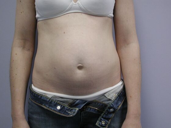 Tummy Tuck Case 10 - Before