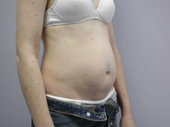 Tummy Tuck: Case 10 - Before