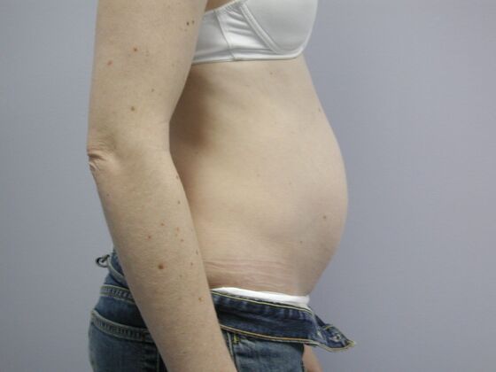 Tummy Tuck: Case 10 - Before