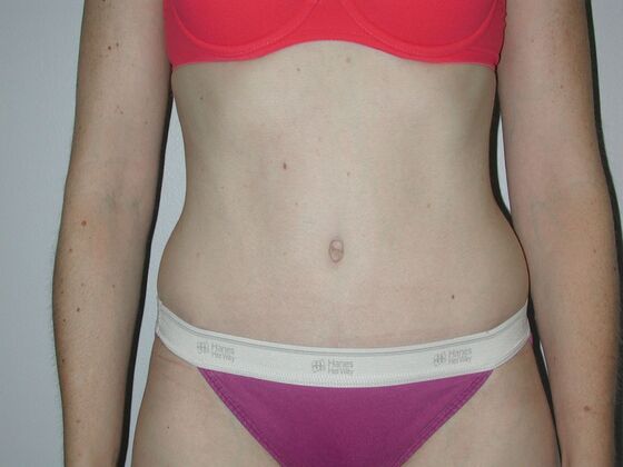 Tummy Tuck Case 10 - After