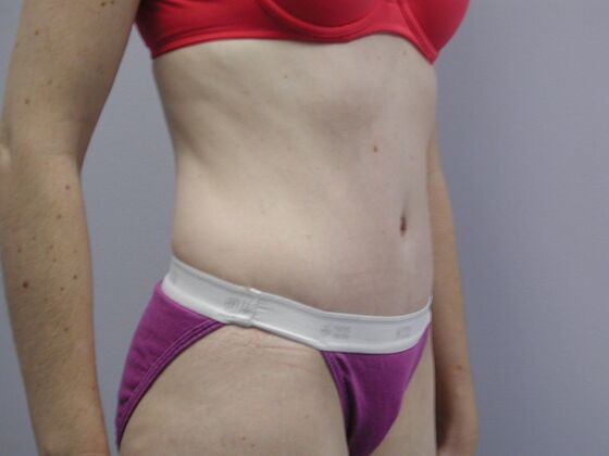 Tummy Tuck: Case 10 - After