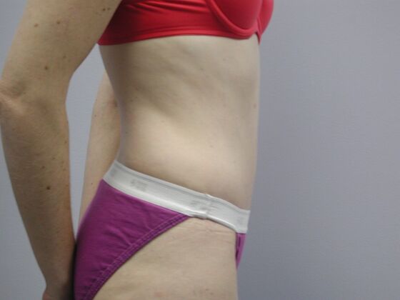 Tummy Tuck: Case 10 - After
