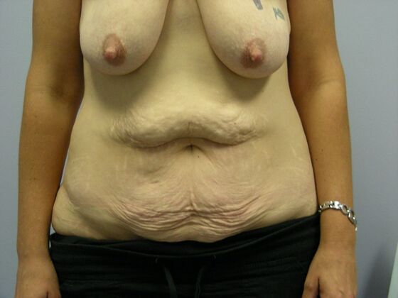 Tummy Tuck Case 1 - Before