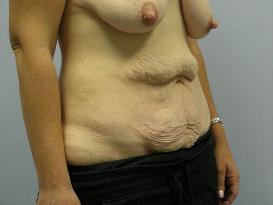 Tummy Tuck: Case 1 - Before
