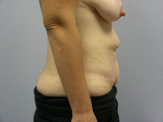 Tummy Tuck: Case 1 - Before