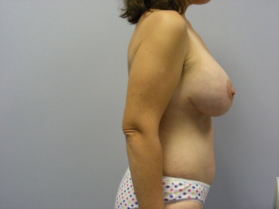 Tummy Tuck: Case 1 - After