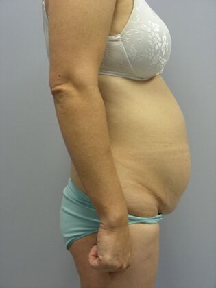 Tummy Tuck: Case 2 - Before
