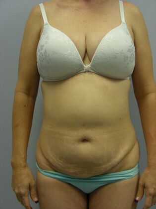 Tummy Tuck Case 2 - Before