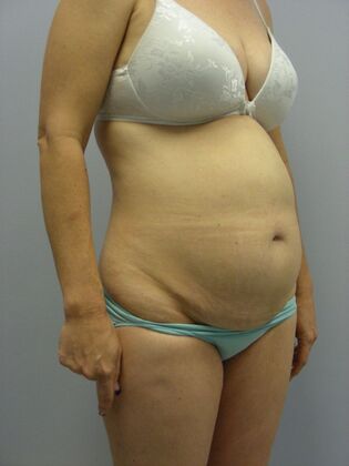 Tummy Tuck: Case 2 - Before