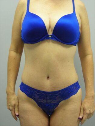 Tummy Tuck Case 2 - After