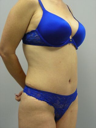 Tummy Tuck: Case 2 - After