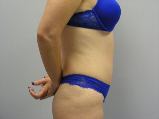 Tummy Tuck: Case 2 - After