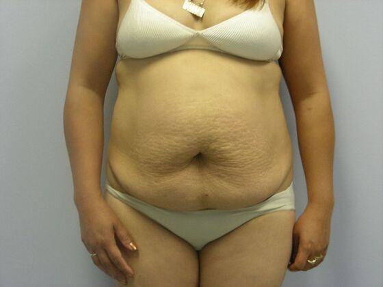 Tummy Tuck Case 3 - Before