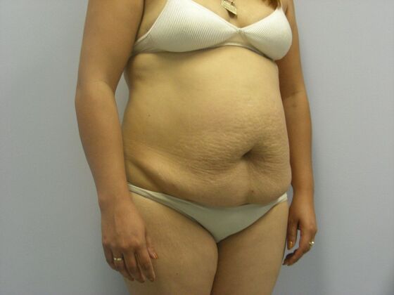 Tummy Tuck: Case 3 - Before