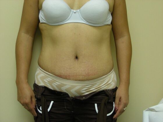 Tummy Tuck Case 3 - After