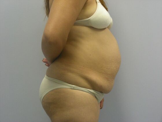 Tummy Tuck: Case 3 - Before