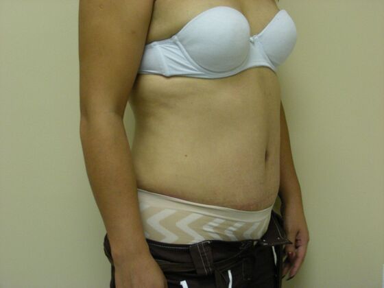 Tummy Tuck: Case 3 - After