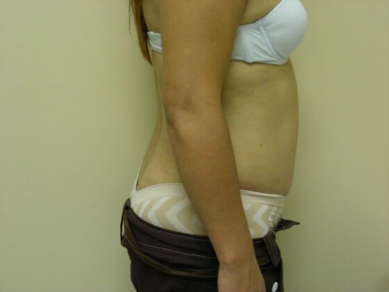 Tummy Tuck: Case 3 - After