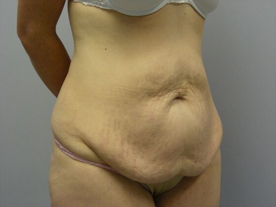 Tummy Tuck: Case 4 - Before