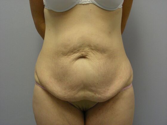Tummy Tuck Case 4 - Before