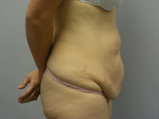 Tummy Tuck: Case 4 - Before