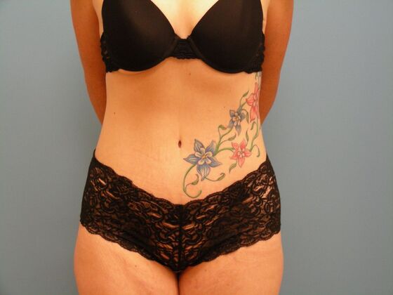 Tummy Tuck Case 4 - After