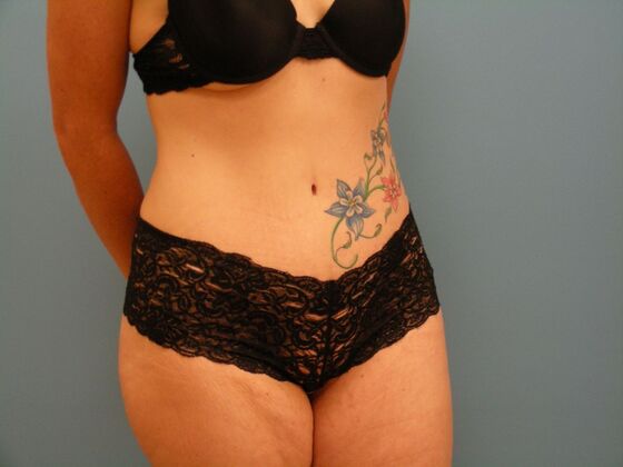 Tummy Tuck: Case 4 - After