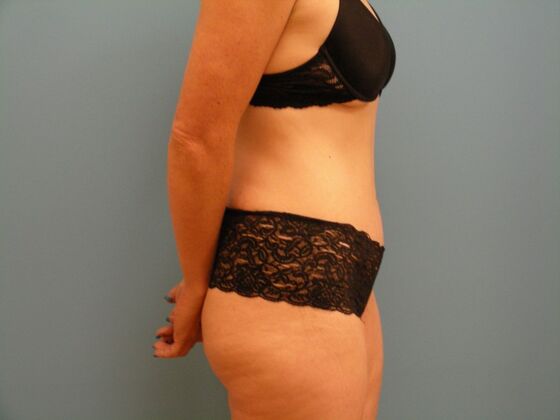 Tummy Tuck: Case 4 - After