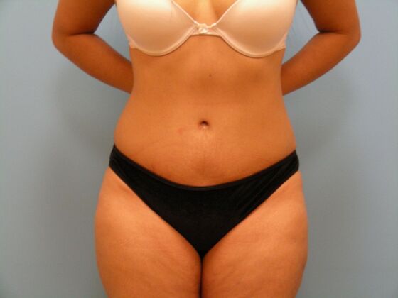 Tummy Tuck Case 5 - After