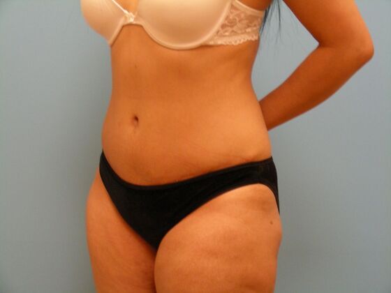 Tummy Tuck: Case 5 - After