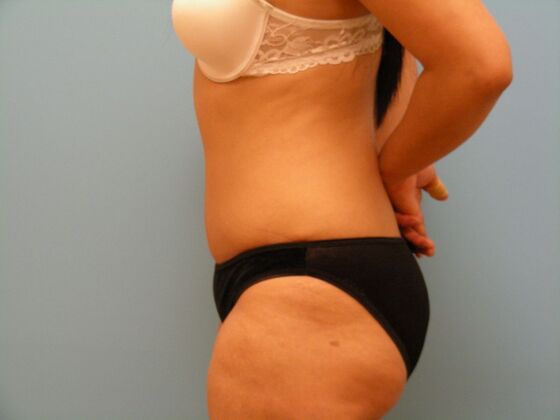 Tummy Tuck: Case 5 - After