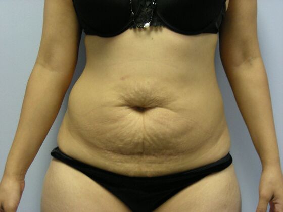 Tummy Tuck Case 5 - Before