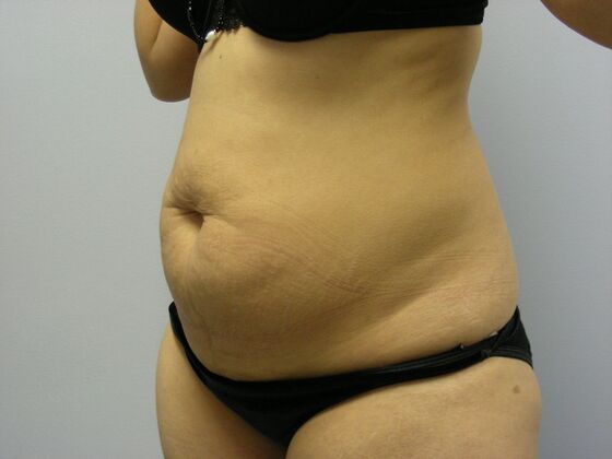 Tummy Tuck: Case 5 - Before