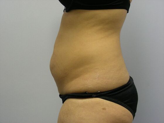 Tummy Tuck: Case 5 - Before
