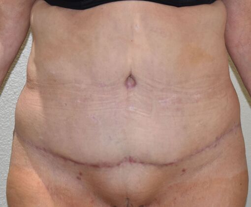 Tummy Tuck (Abdominoplasty) Case 544 - After