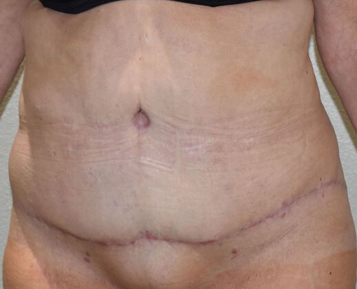 Tummy Tuck (Abdominoplasty): Case 544 - After