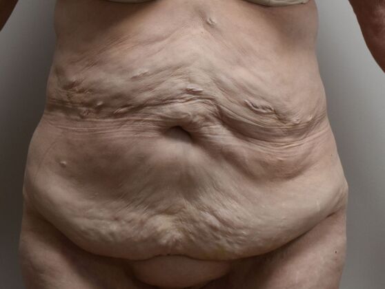 Massive Weight Loss : Case 182 - Before