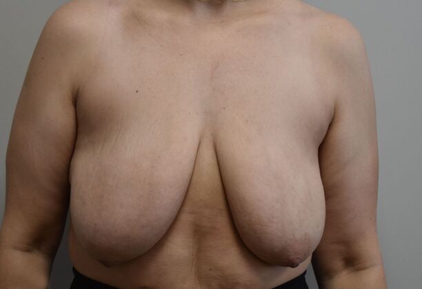 Breast Lift (Mastopexy) Case 244 - Before