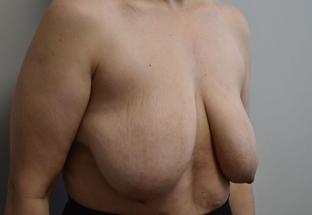 Breast Lift (Mastopexy): Case 244 - Before